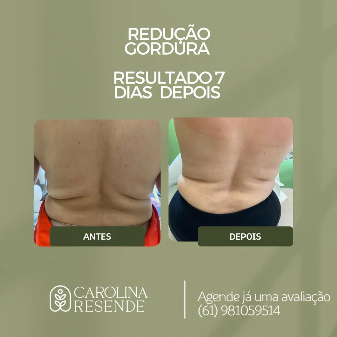 Gordura localizada — antes e depois