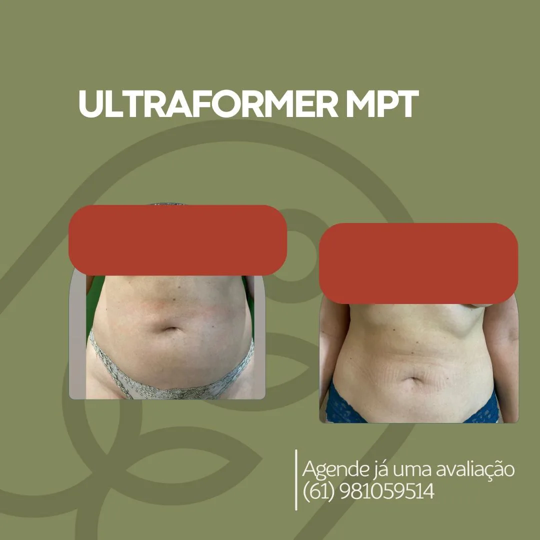 Firmeza abdominal — antes e depois